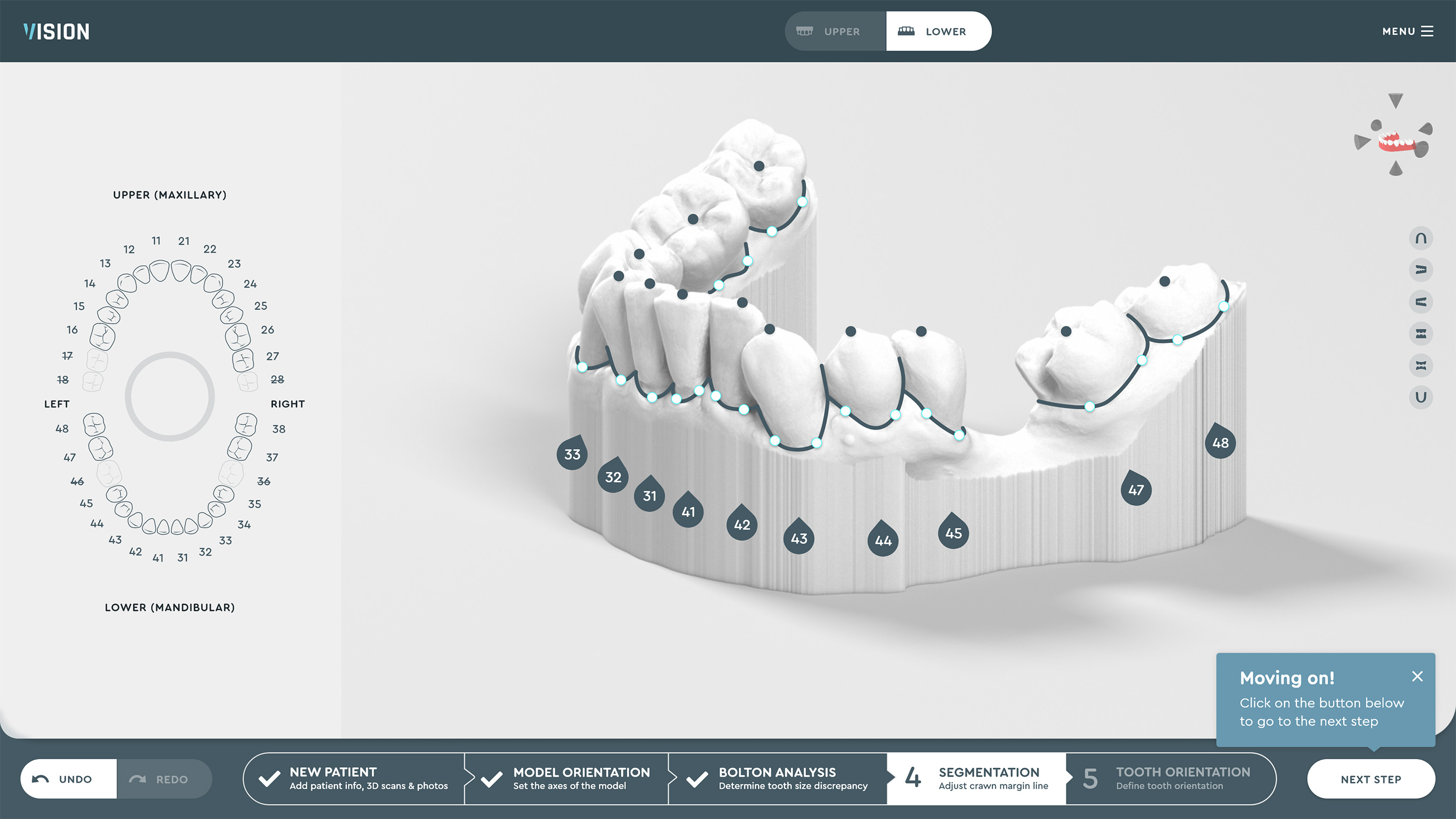 SoftSmile Software: Automated segmentation of teeth and gums