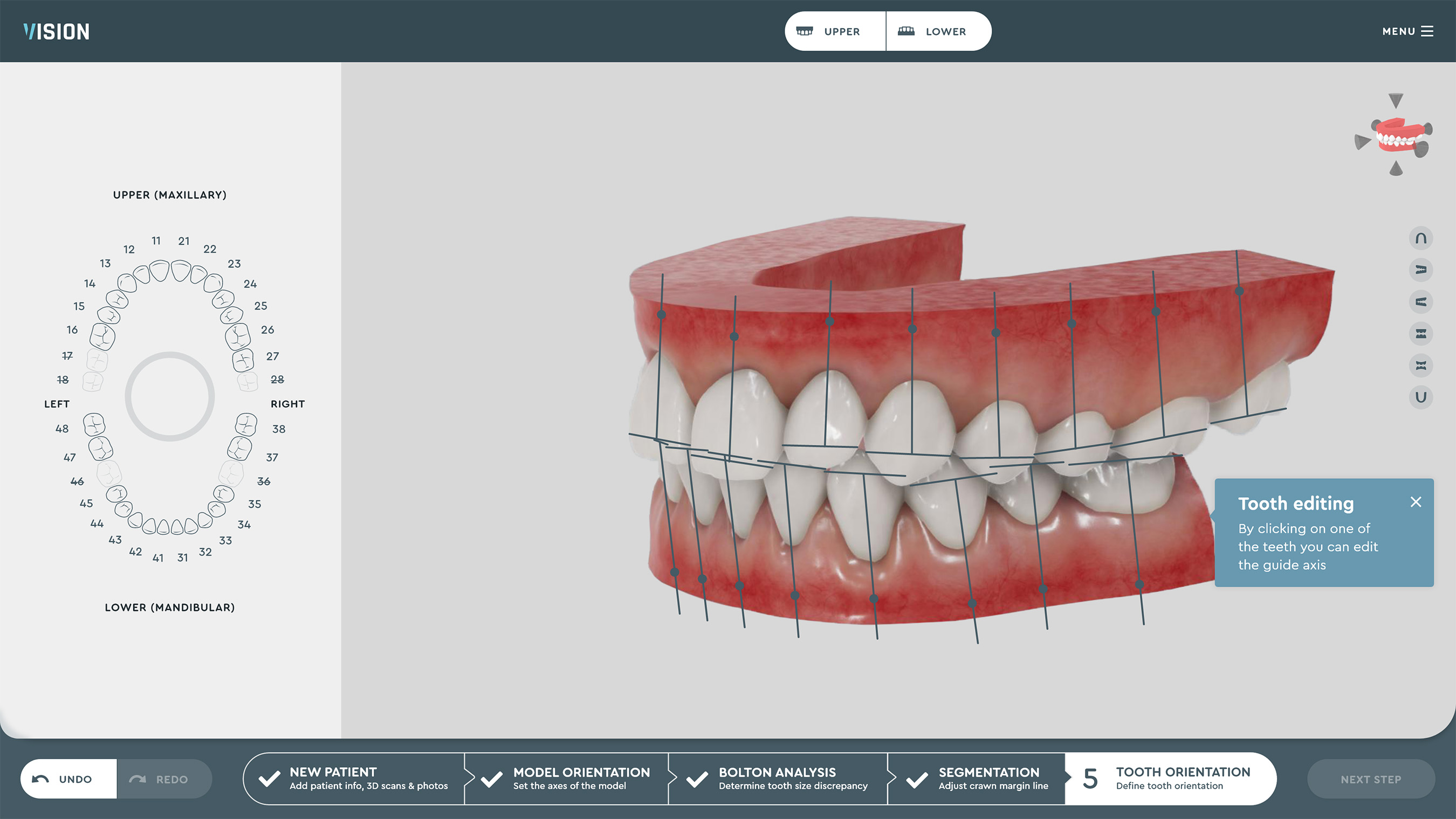 SoftSmile Software: Tooth Orientation