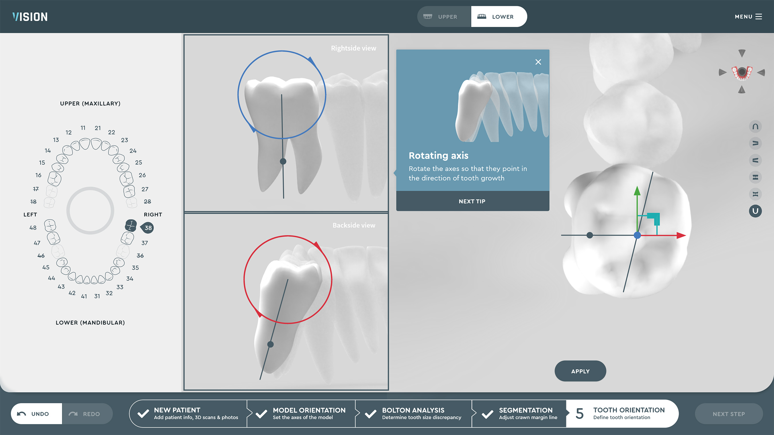 SoftSmile Software: Automated detection of tooth axis