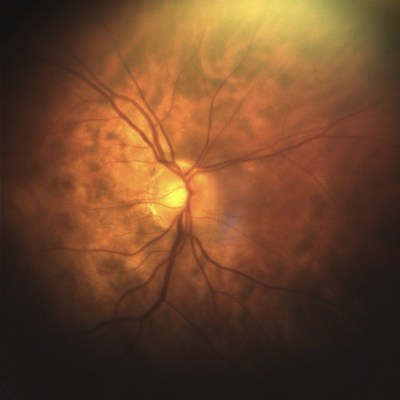 Retinal imagery acquired with the new epiCam fundus camera