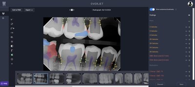Overjet analyzes dental X-rays to add precise, colorful annotations.