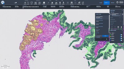 Qritive's QAi Prostate Grade algorithm integrated with Roche navify digital pathology platform.