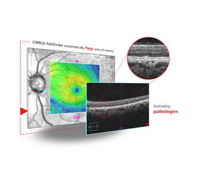 ZEISS CIRRUS PathFinder AI Tool - awaiting CE mark, not available in all countries