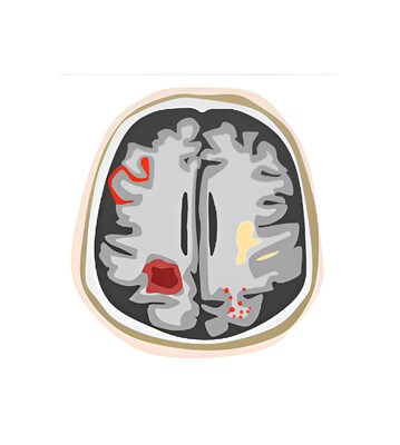 Figure 1: Example of how ARIA can present itself on a brain MRI scan