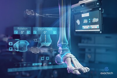 Exactech Announces First Surgeries with the World’s First Surgical Navigation for Total Ankle Replacement