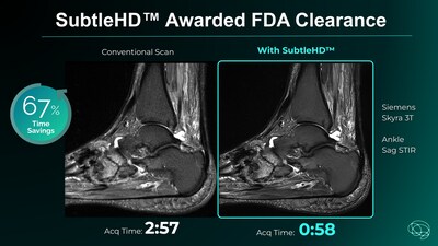 SubtleHD wins FDA Clearance