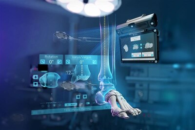 Exactech Celebrates International Debut of GPS Ankle, the World’s First Navigation System for Ankle Replacement Surgery