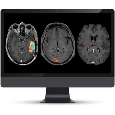 All 3 modules of NeuroQuant&reg; Brain Tumor on a monitor.