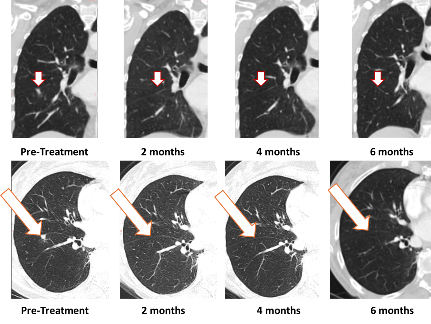 Treatment with Bria-OTS monotherapy resulted in 100% resolution of tumor in the right lung of the metastatic breast cancer (MBC) patient following 2 months of therapy and confirmed at 4, and 6 months of therapy  (axial and coronal views)