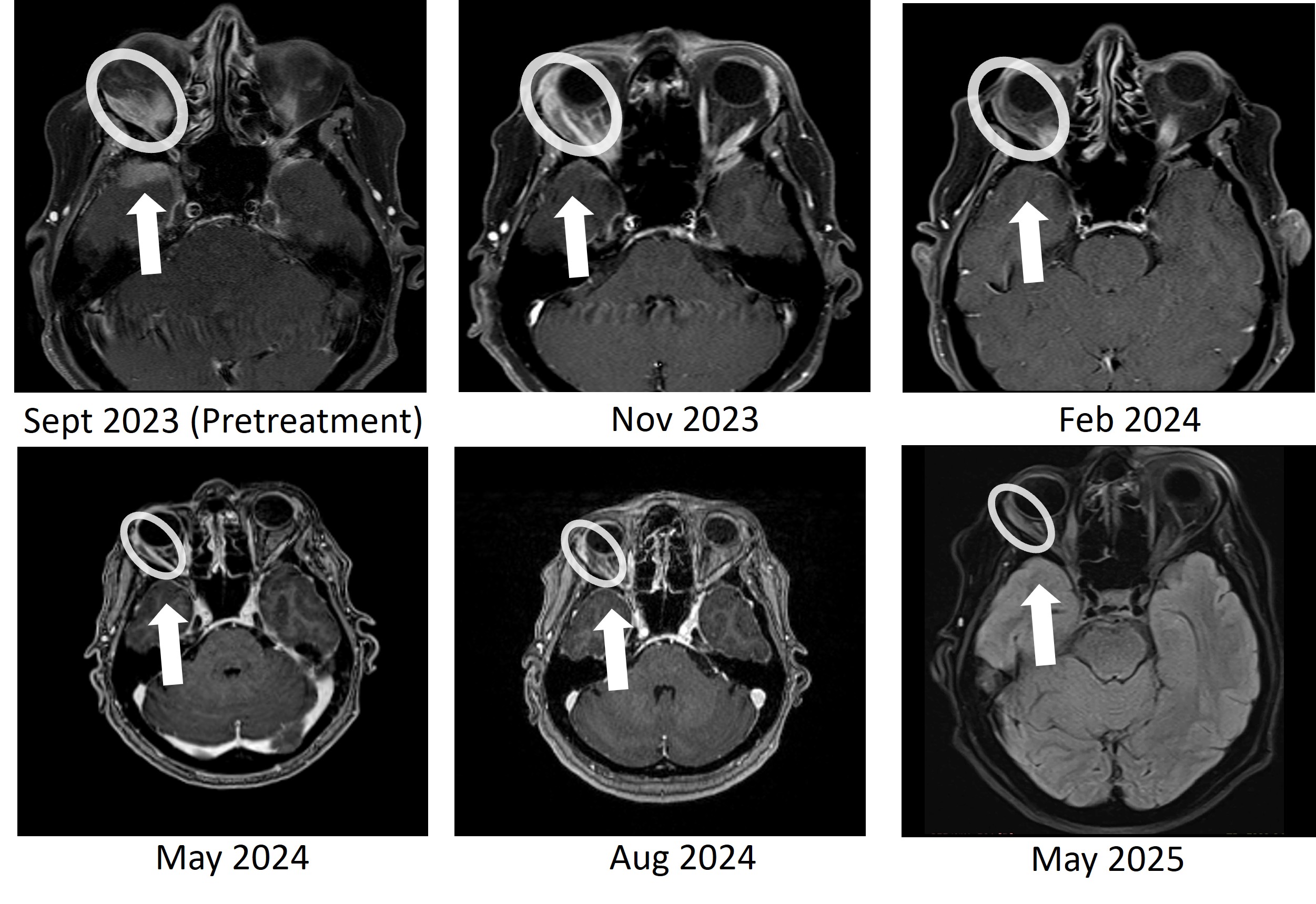 Bria-IMT treatment resulted in complete resolution of the right temporal lobe lesion and continued regression of the right orbital (behind the eye) tumor. The right temporal lobe lesion is no longer detectable on the images taken at 8 months (May 2024), 11 months (Aug 2024), and 20 months (May 2025).