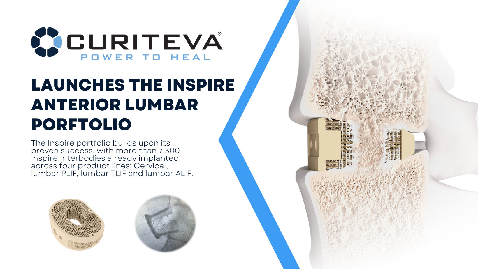 Inspire Anterior Lumbar Launch