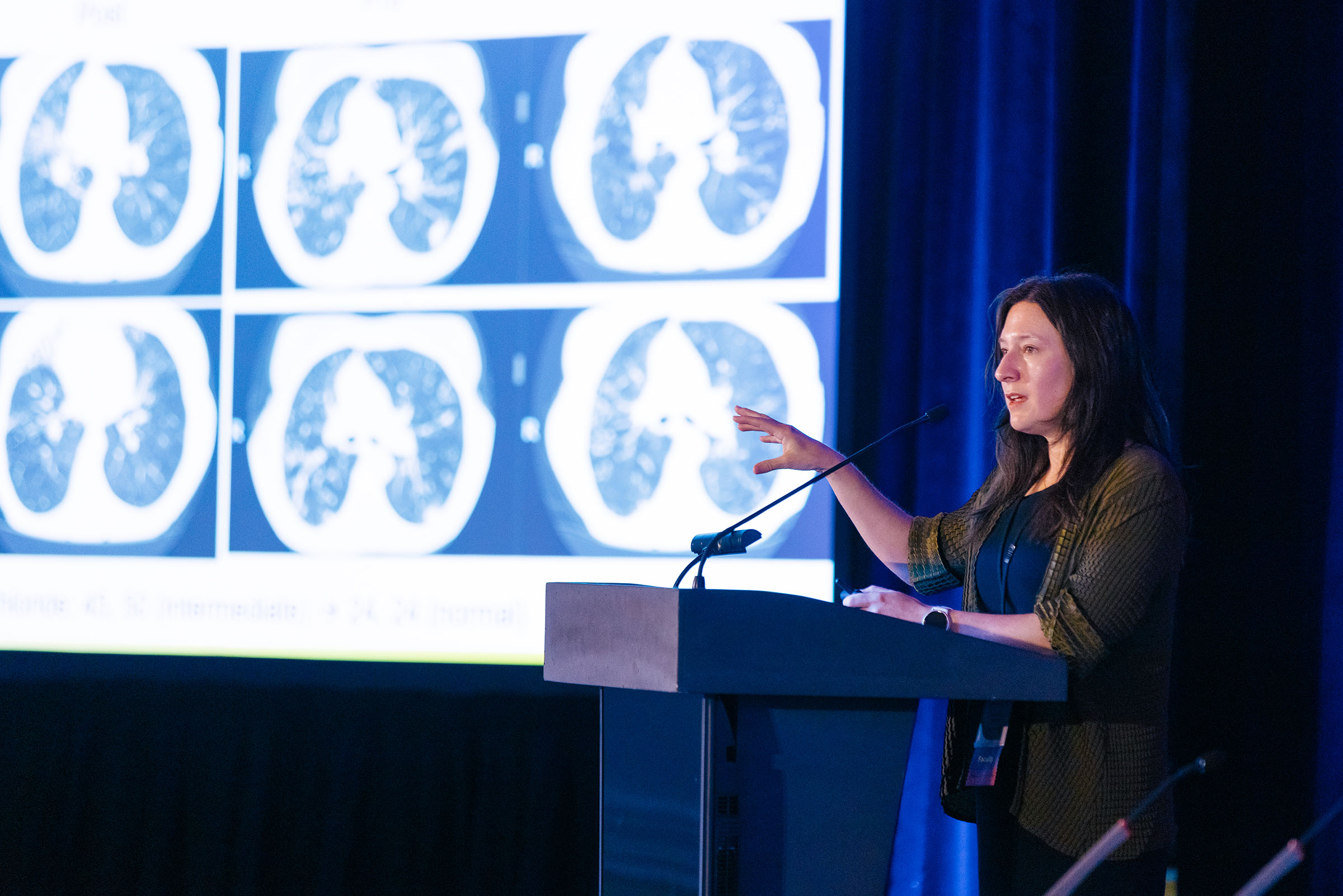 Chest CT scans show if there are any abnormalities affecting the lungs. Dr. Elisa Ignatius from Johns Hopkins Medicine recently spoke about the comorbidities in NTM and bronchiectasis before patients and caregivers at the 2025 NTM and Bronchiectasis Patient Conference held in California. Chest CT scans show if there are any abnormalities affecting the lungs. Dr. Elisa Ignatius from Johns Hopkins Medicine recently spoke about the comorbidities in NTM and bronchiectasis before patients and caregivers at the 2025 NTM and Bronchiectasis Patient Conference held in California.