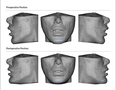 Virtual Surgical Planning (VSP) for corrective jaw and chin surgeries (genioplasty) Virtual Surgical Planning (VSP) for corrective jaw and chin surgeries (genioplasty)