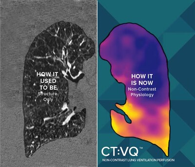 4DMedical CT:VQ™ turns a routine chest CT into ventilation–perfusion imaging—no contrast required.