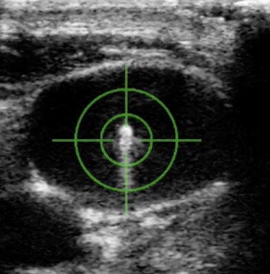 Precise robotic needle placement with CERTA