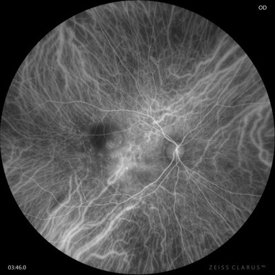 CLARUS 700 with ICGA modality