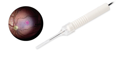 New Midfield endoillumination light probe with directed light