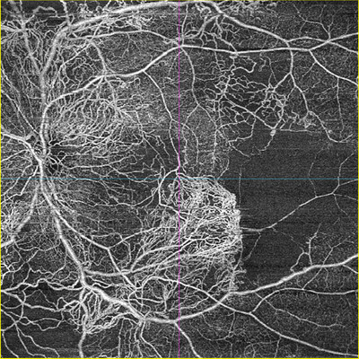 ZEISS AngioPlex OCT Angiography