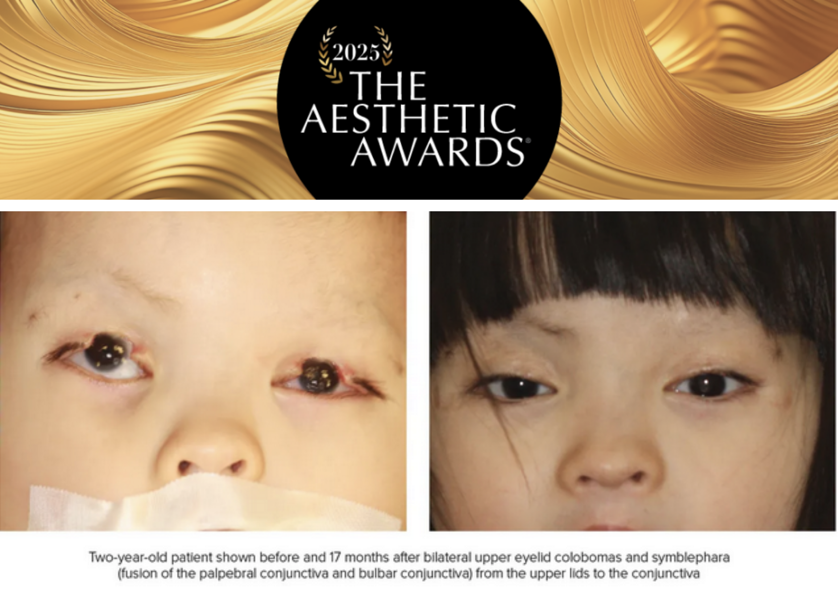 Before-and-After Eyelid Reconstruction