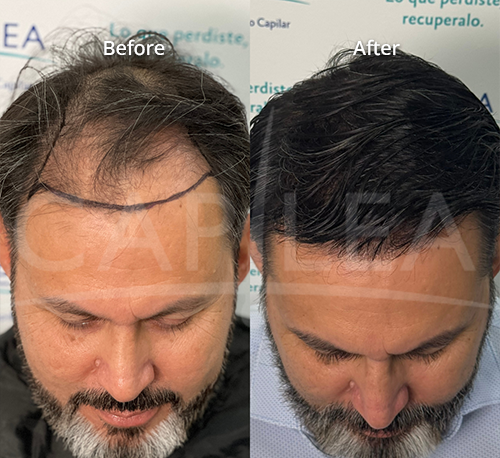 Capilea Mexico Unveils New Insights on Surge of US Patients Choosing Mexico for Hair Transplants
