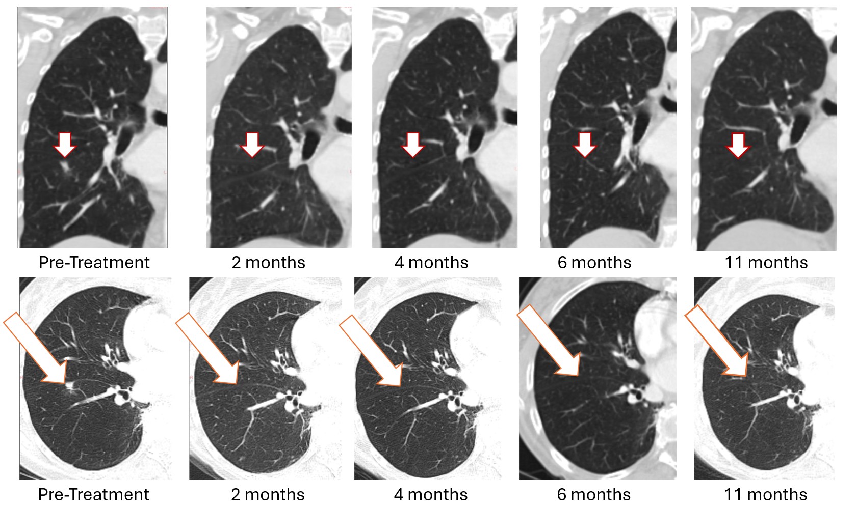 BriaCell Reports Sustained Complete Resolution of Lung Metastasis in Bria-OTS&trade; Patient