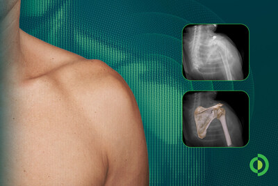 Advita Ortho highlights new research on AI-generated shoulder digital twins, reflecting a growing focus on transforming surgical data into clinical intelligence to help surgeons plan with greater confidence, execute more precisely and better understand factors influencing patient outcomes.