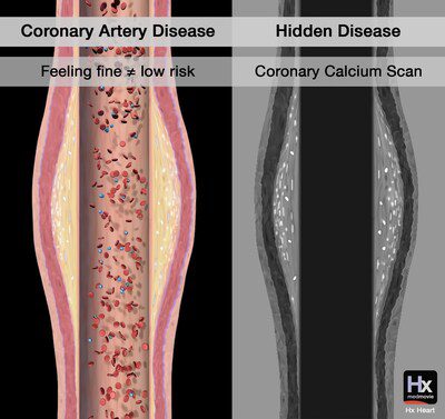 From Medmovie's Youtube Short: Hidden Disease - Coronary Artery Disease (CAD)